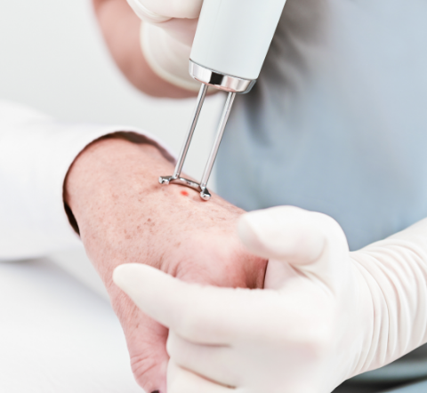 Präzise Hautbehandlung bei Dr. Peter Seiringer: Einsatz moderner Lasertechnologie durch geschultes Fachpersonal zur Entfernung von Hautveränderungen. Schonende und effektive Methoden in der dermatologischen Praxis.